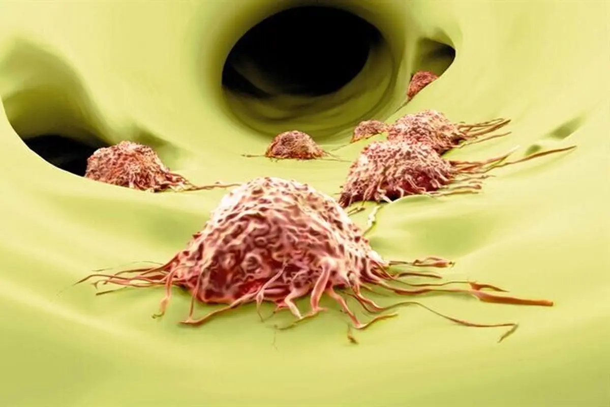 پیشگیری از متاستاز تومور با به خواب بردن سلول‌های سرطانی!