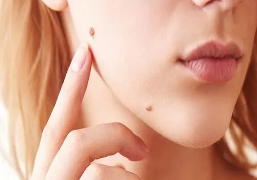 اگر خال شما این ویژگی ها را دارد باید به پزشک مراجعه کنید