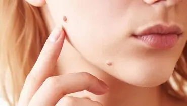 چگونه یک خال ساده تبدیل به سرطان می‌شود؟