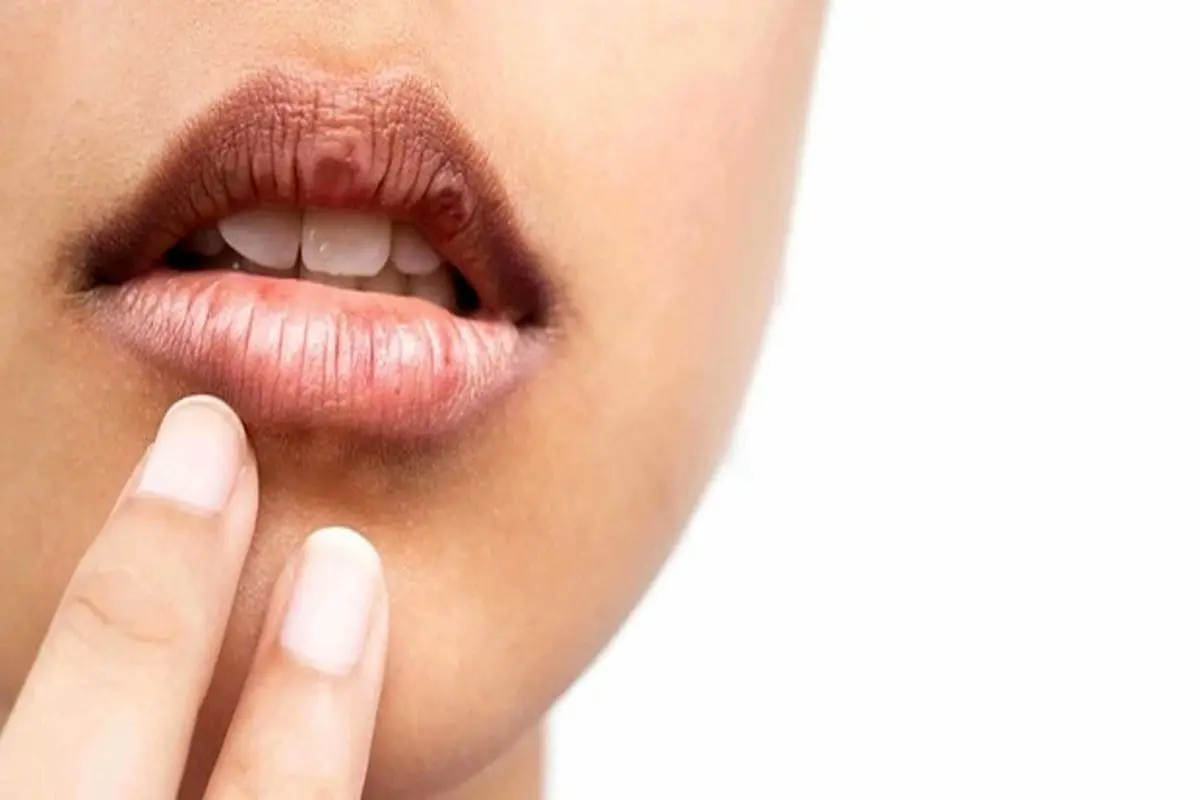 علت خشکی دهان چیست؟ + درمان