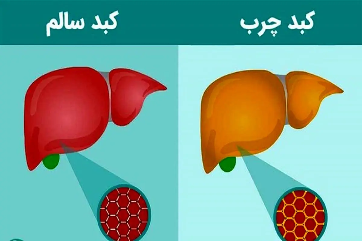 یک ژن مخرب در بیماری کبد چرب شناسایی شد