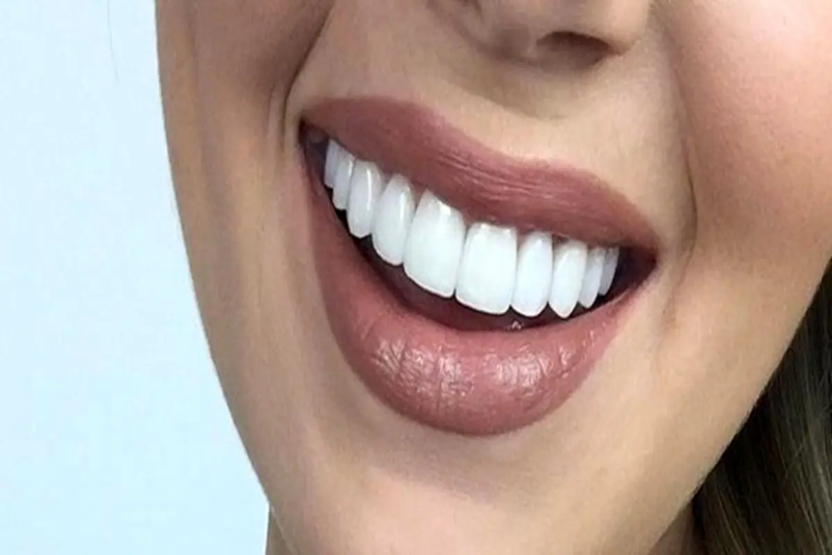 عارضه دندانی که با استرس تشدید می‌شود