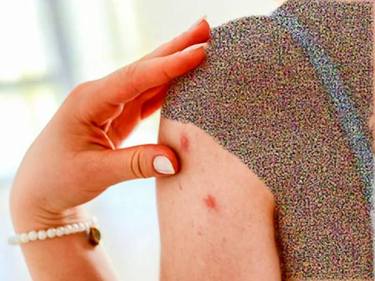 راه‌های پیشگیری از سفت دانه یا پاپول +nvlhk