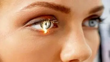 سندرم خشکی چشم و گلوکوم+ درمان همزمان