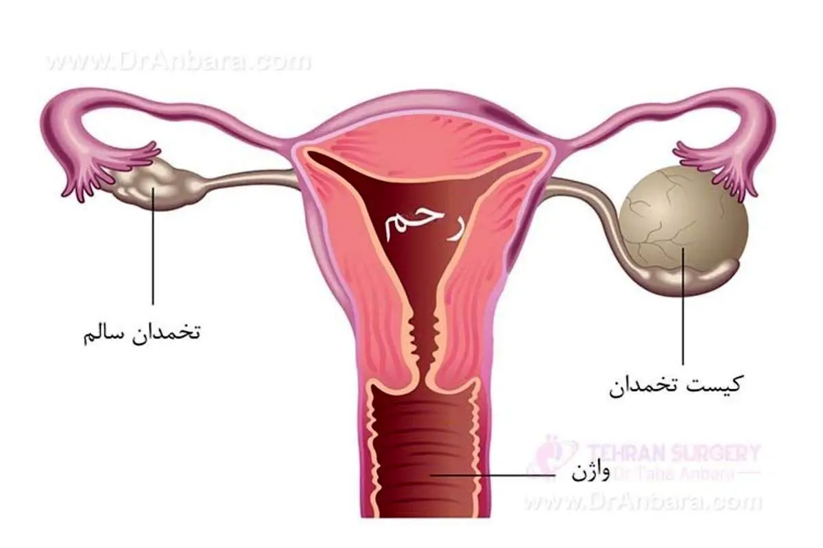 زنان چاق و پر کیستی تخمدان