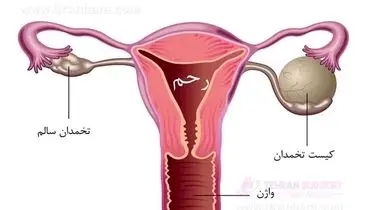 زنان چاق و پر کیستی تخمدان