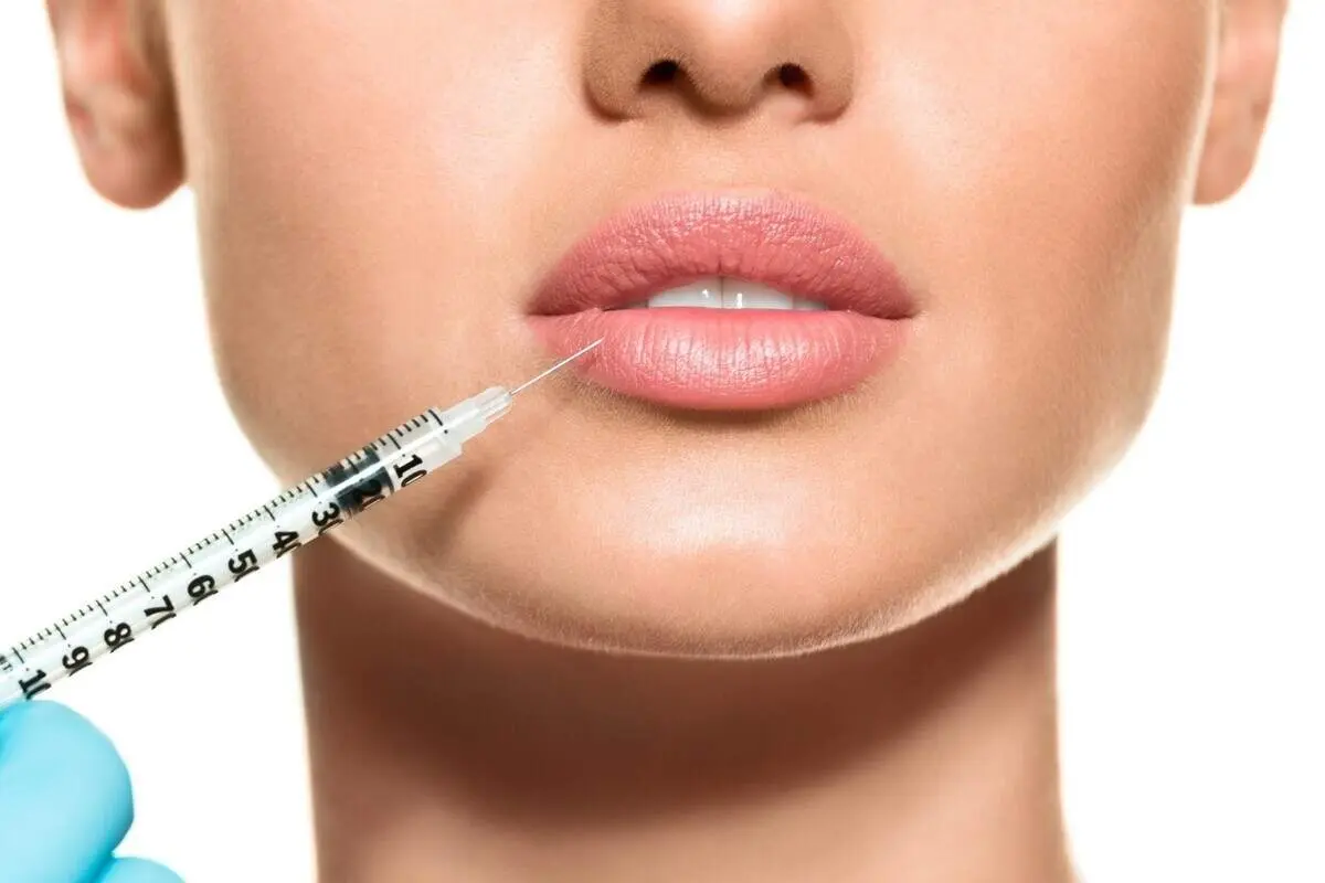 هزینه تزریق ژل لب (طبیعی، روسی و ...) در سال ۱۴۰۱
