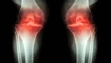 روش درمان آرتروز با شناسایی سیگنال درد