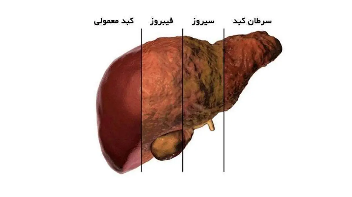 درمان کبد چرب دارویی نیست/ درمان با این غذاها!