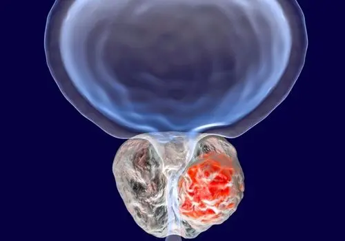 کنترل سرطان پروستات تنها با یک راهکار آسان