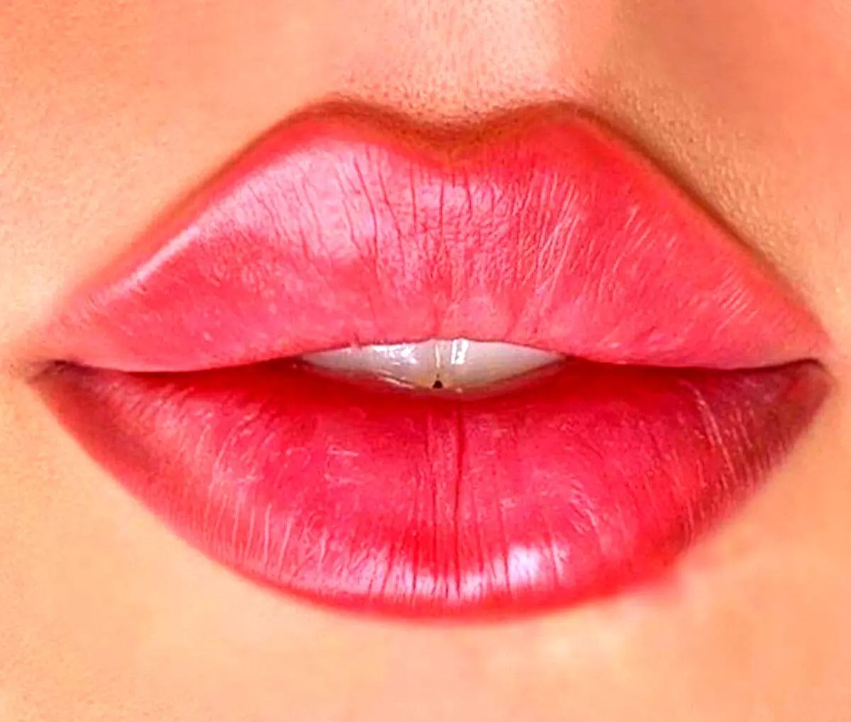 تزریق ژل لب و همه چیز درباره آن
