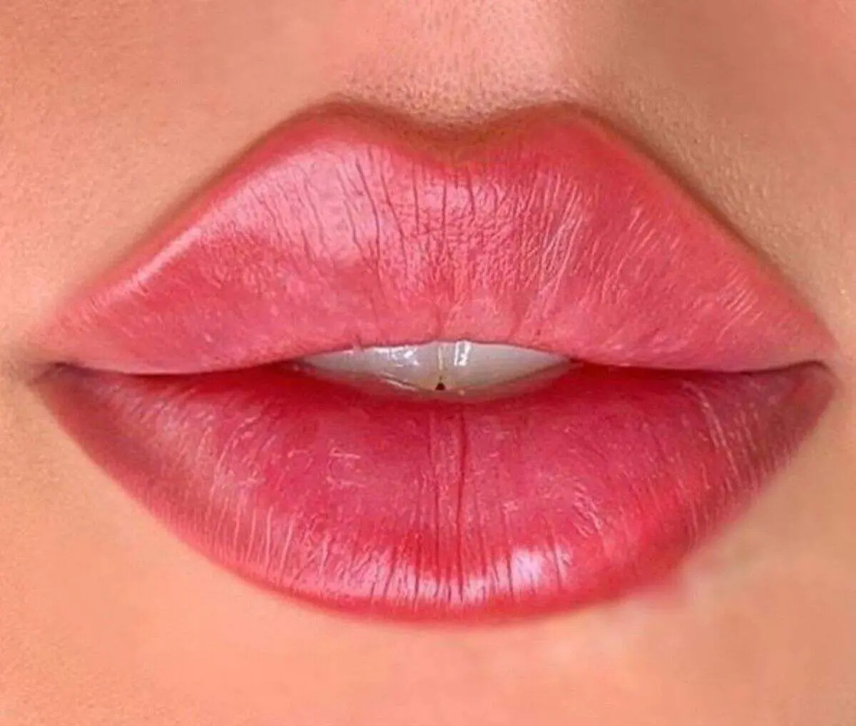 تزریق ژل لب و همه چیز درباره آن