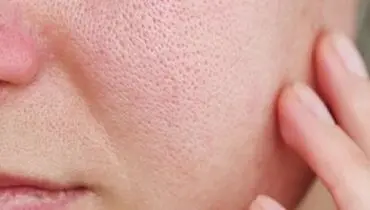 راهکارهای طبیعی برای از بین بردن قرمزی صورت