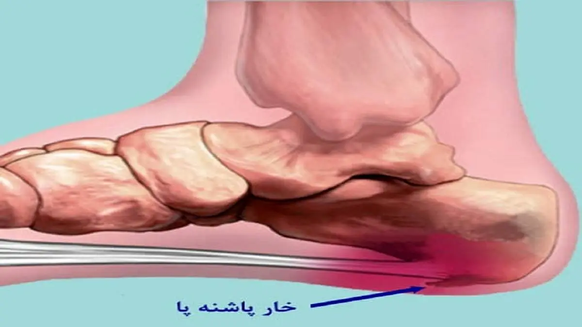 راههای درمان خارپاشنه بدون جراحی