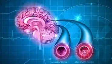 داروهای ضدتهوع ریسک سکته مغزی را افزایش می دهند