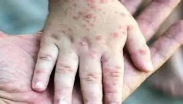 ریسک پایین ابتلا به بیماری سرخک در واکسینه شده‌ها