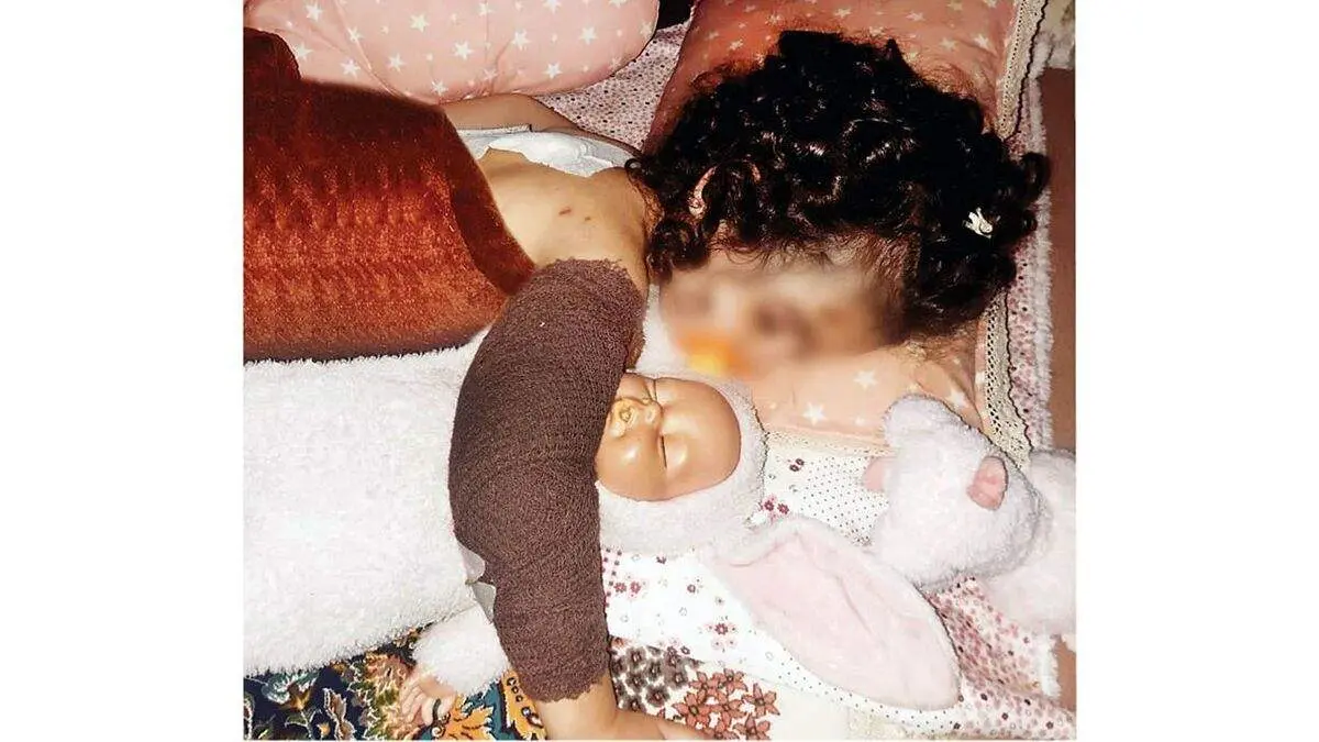 جزئیات حمله سگ ولگرد در فردیس/ زخمی دختربچه سطحی بود