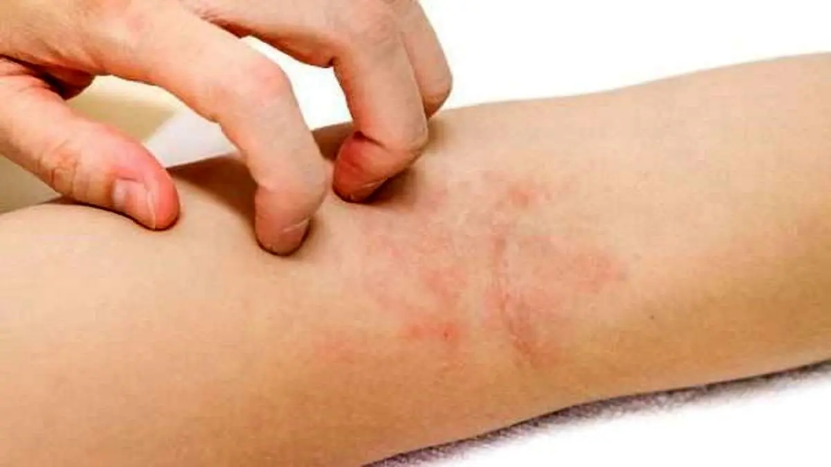 آیا اگزما از طریق لمس منتقل میشود؟