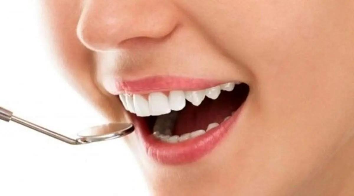 چه کسانی میتوانند دندانهایشان را لمینت کنند؟