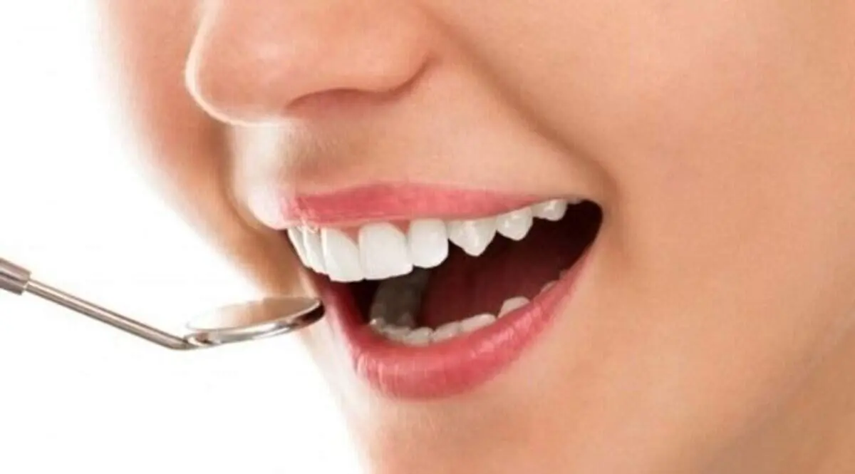 چه کسانی می‌توانند دندان‌هایشان را لمینت کنند؟