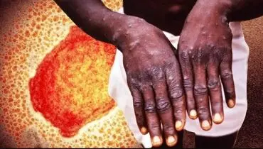 مورد مشکوکی از ابتلا به آبله میمونی در کشور مشاهده نشده است