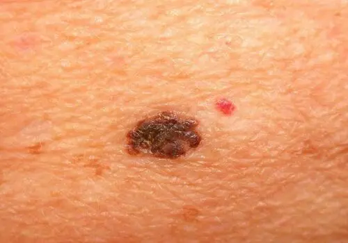 علائم بیماری‌های کبدی را بشناسید