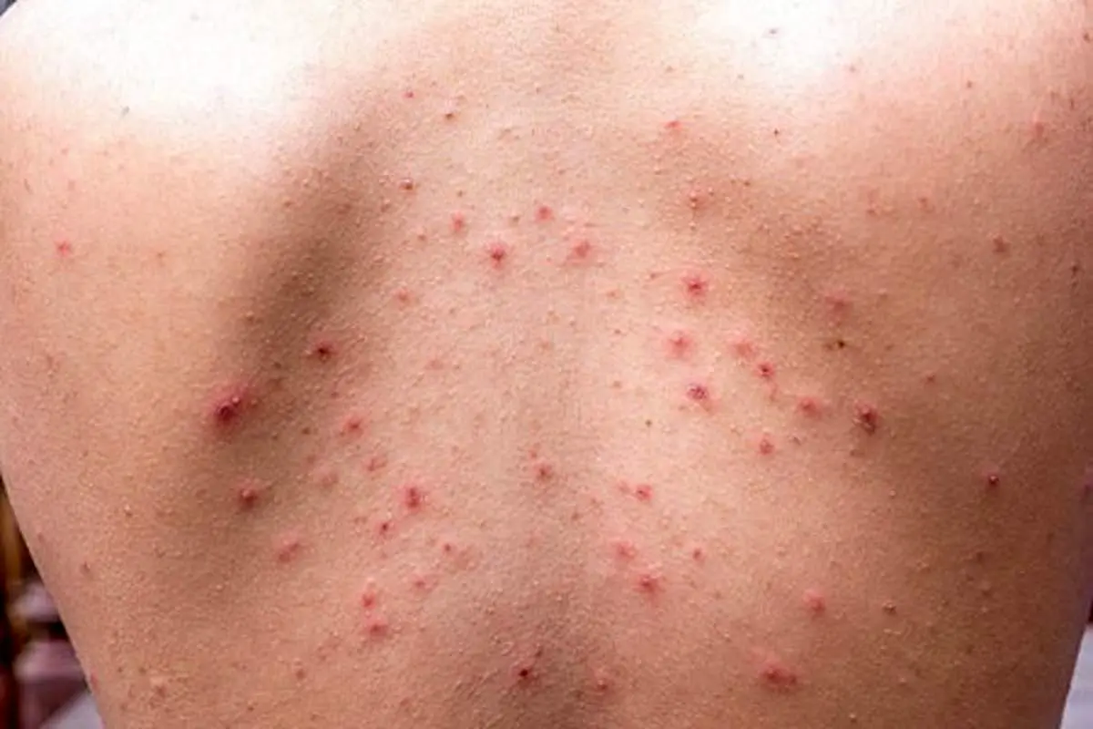 جوش کمر: چگونه از شر جوش های کمر خود خلاص شوید؟