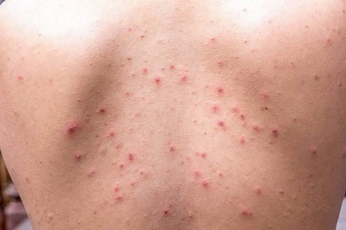 جوش کمر: چگونه از شر جوش های کمر خود خلاص شوید؟