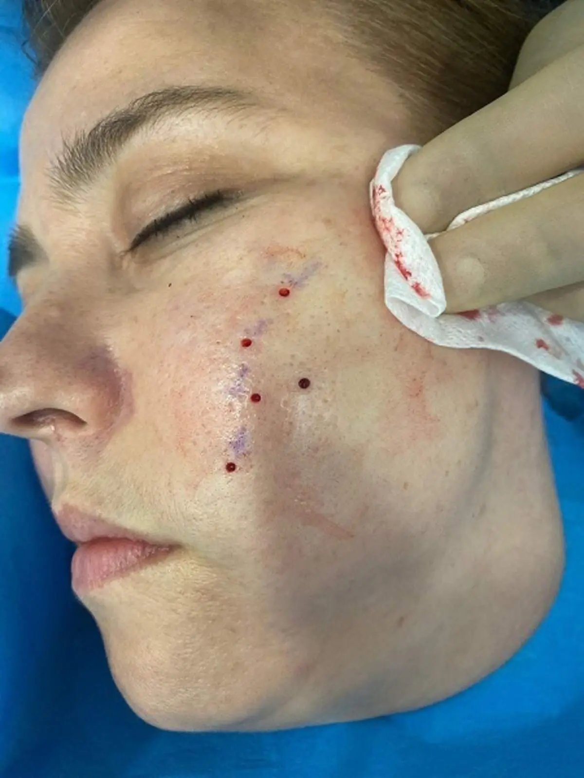رفع اسکارهای عمیق با کمک پانچ صورت