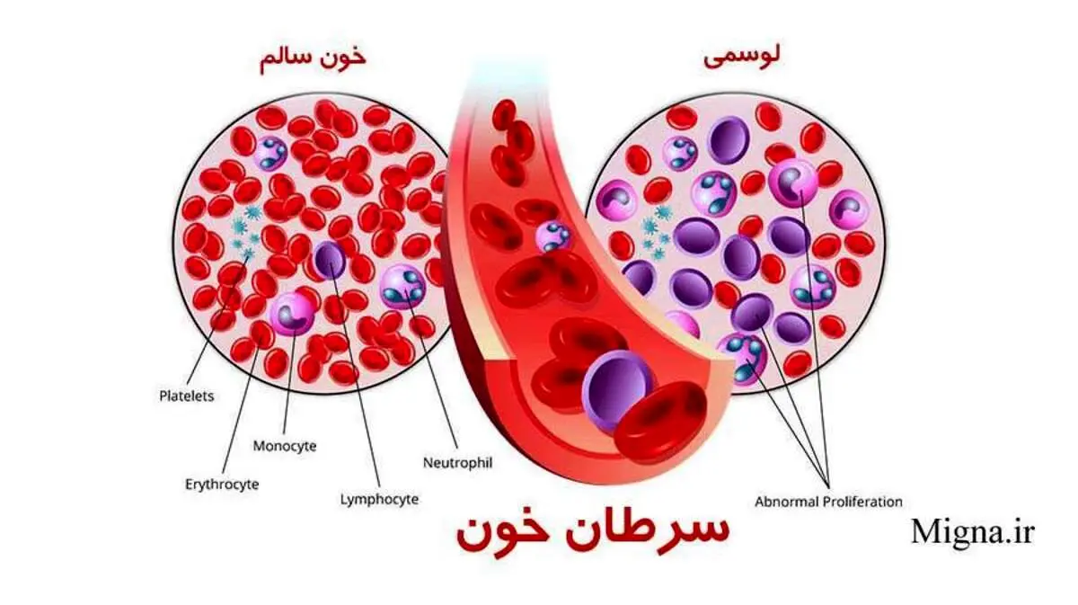 سرطان خون در جوانی به معنای طول عمر کوتاه تر است