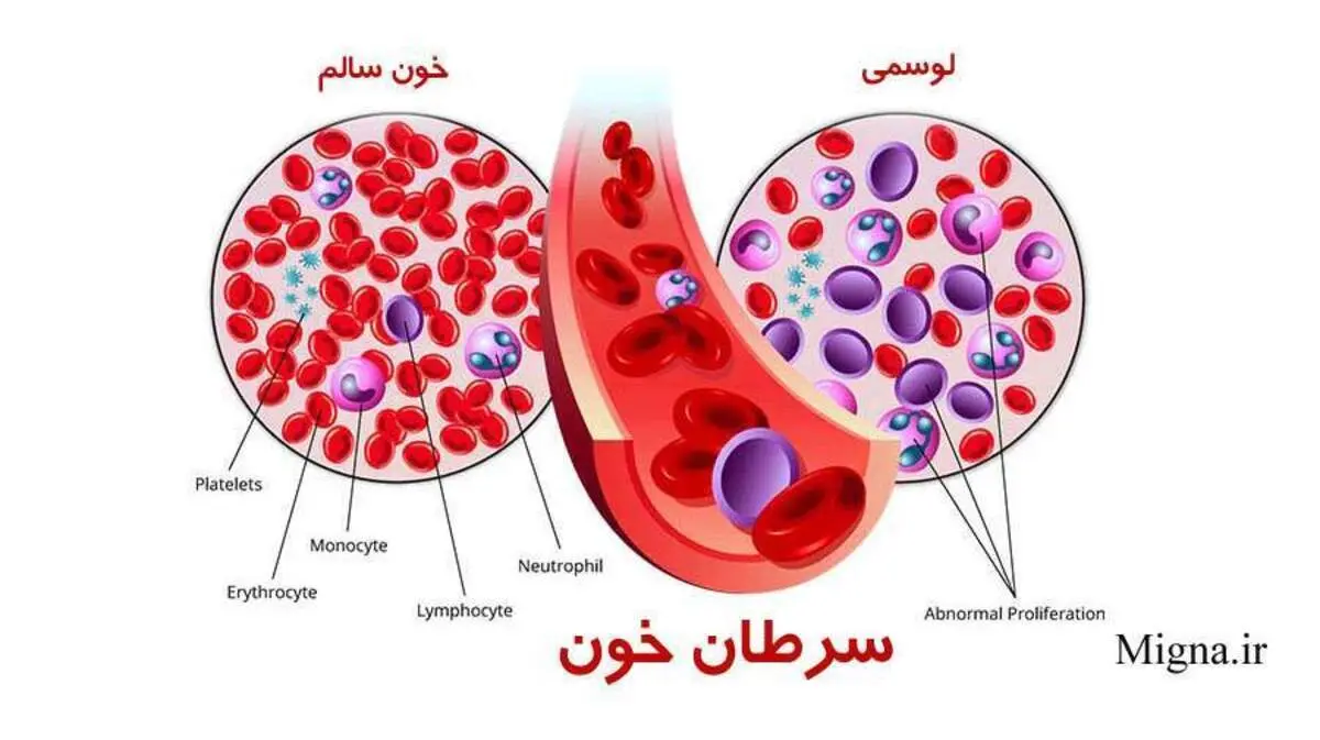سرطان خون در جوانی به معنای طول عمر کوتاه تر است