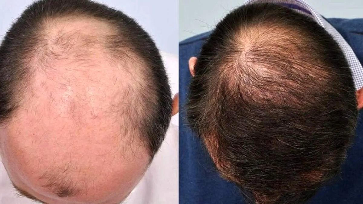 تولید دارویی جدید برای احیای مو‌های ریخته
