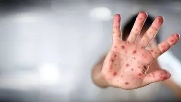 آبله میمون به همسایگی ایران رسید + عکس