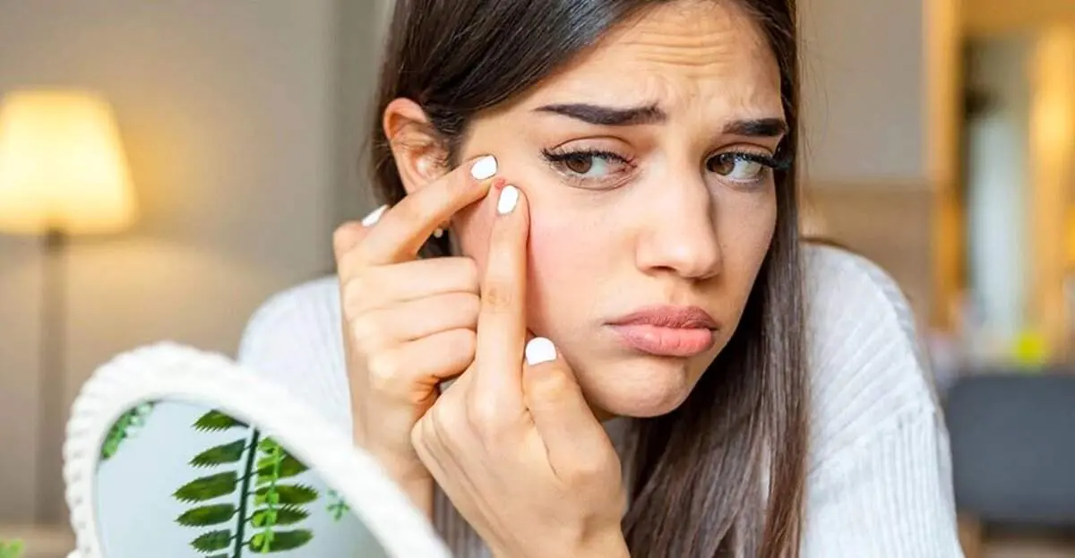 چگونه چرخه قاعدگی بر آکنه تأثیر می‌گذارد؟