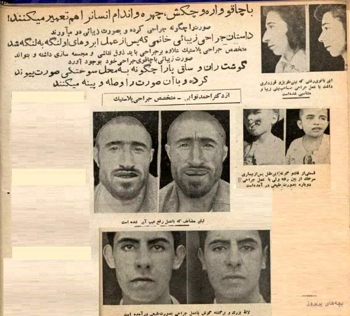 اولین عمل بینی در ایران را چه کسی انجام داد؟ | جراحی زیبایی با اره و چکش + تصاویر