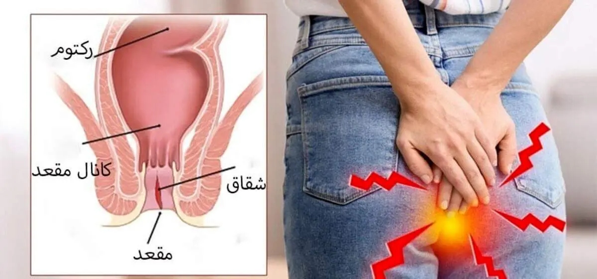 علل و علائم شقاق مقعد در زنان و روش های درمان