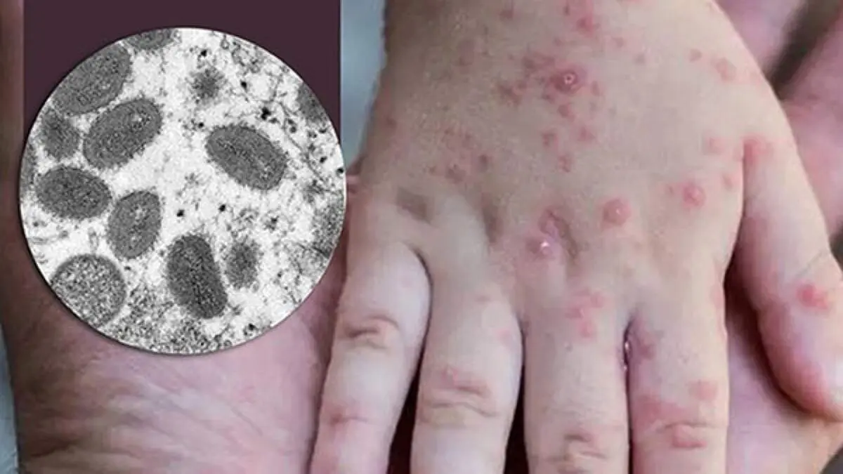 کرم دست و صورت عامل ابتلا به آبله میمون