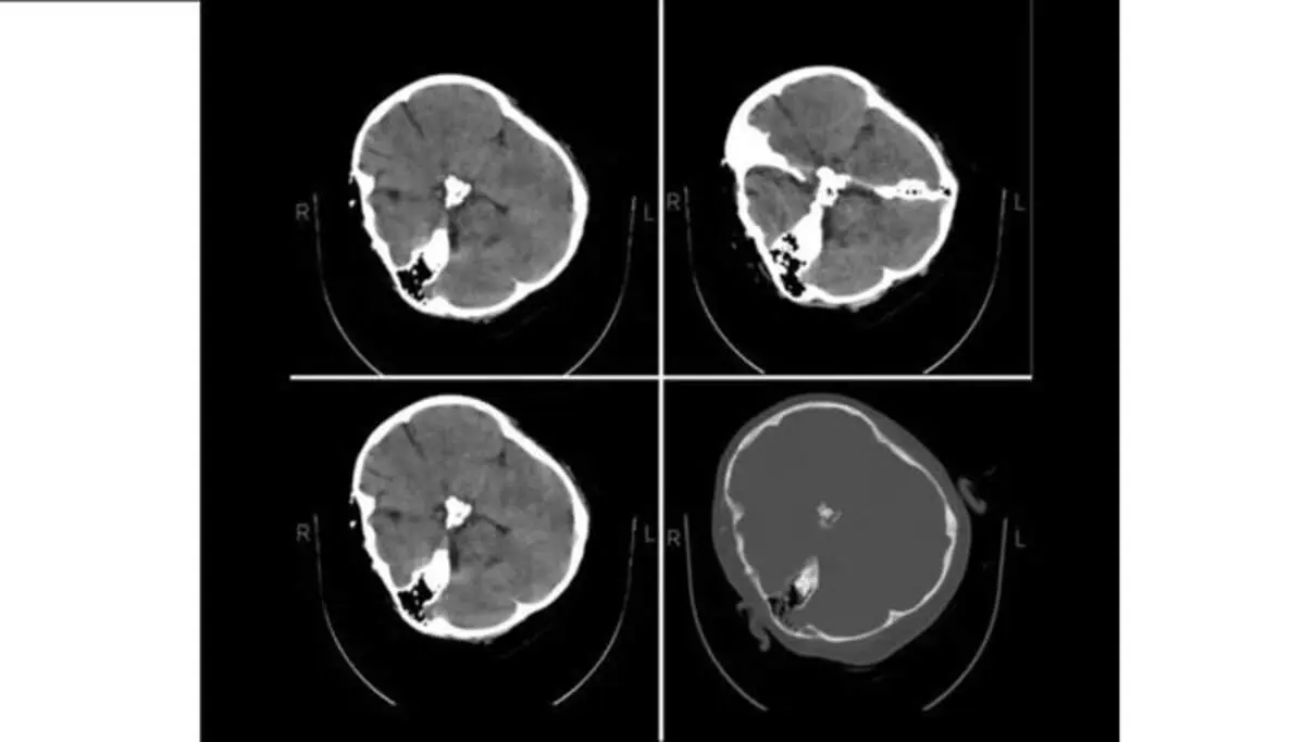 هیچ شواهدی از خونریزی مغزی در تصاویر سی‌ تی‌ اسکن «مهسا امینی» دیده نمی‌شود