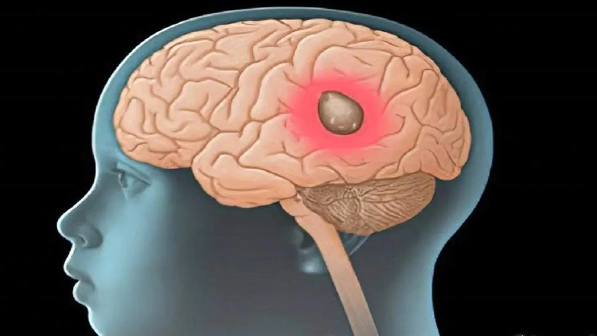 داروی خارق العاده برای درمان بدخیم‌ترین تومور مغزی