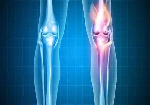 این ورزش شما را از شر آرتروز خلاص میکند