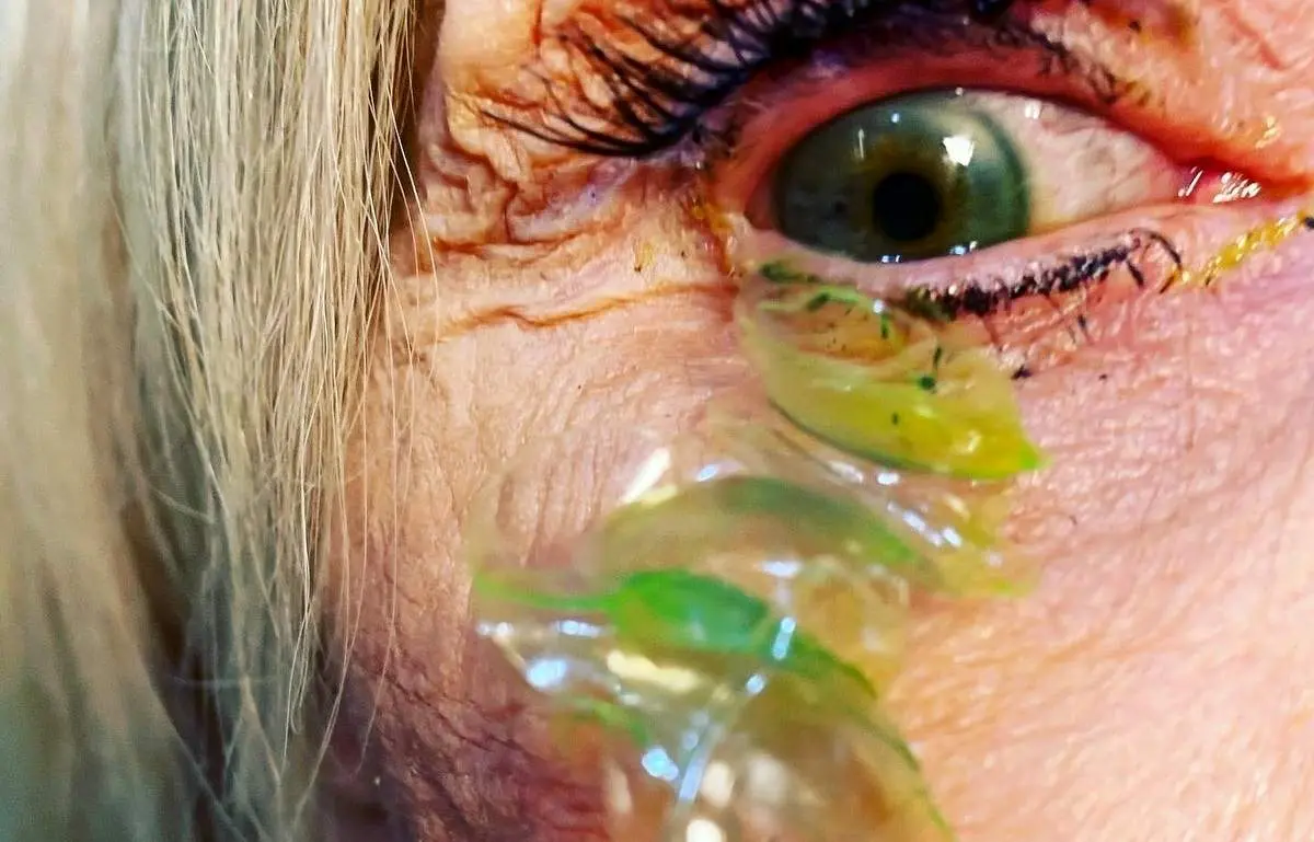 خارج کردن ۲۳ لنز از چشم یک زن! + فیلم