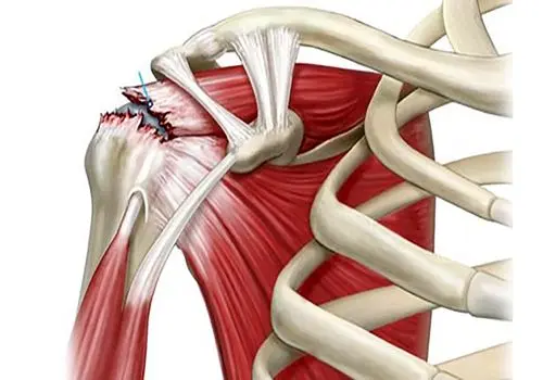 توصیه کارشناسان برای پیشگیری از آسیب تاندون‌ها
