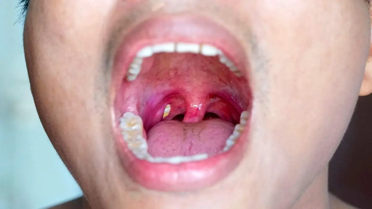 روش جلوگیری از بیماری‌های لوزه + فیلم