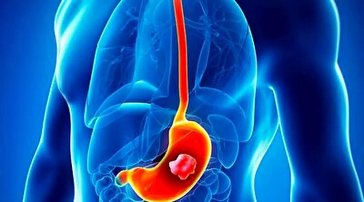 راهکارهایی برای جلوگیری از سرطان معده+ فیلم