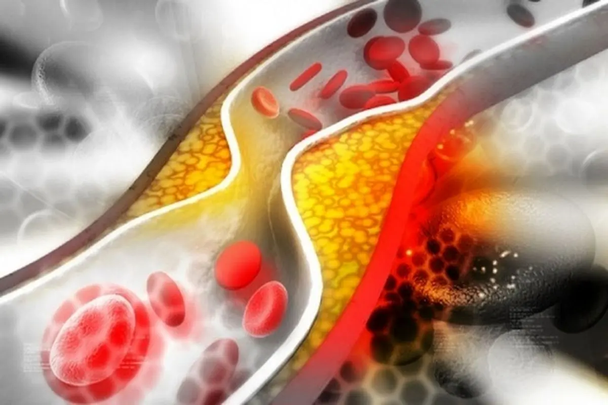 چربی خون موجب پیشرفت سرطان می‌شود؟