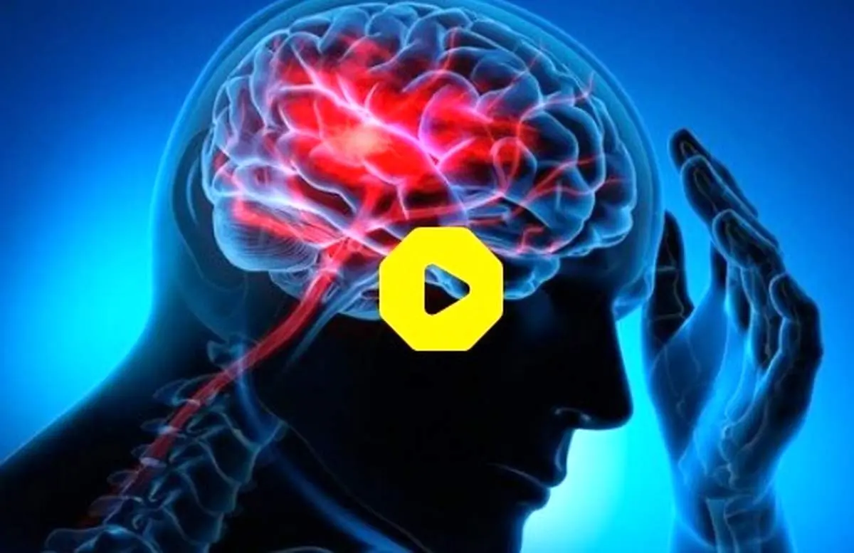علت اصلی سکته مغزی به زبانی ساده+ فیلم