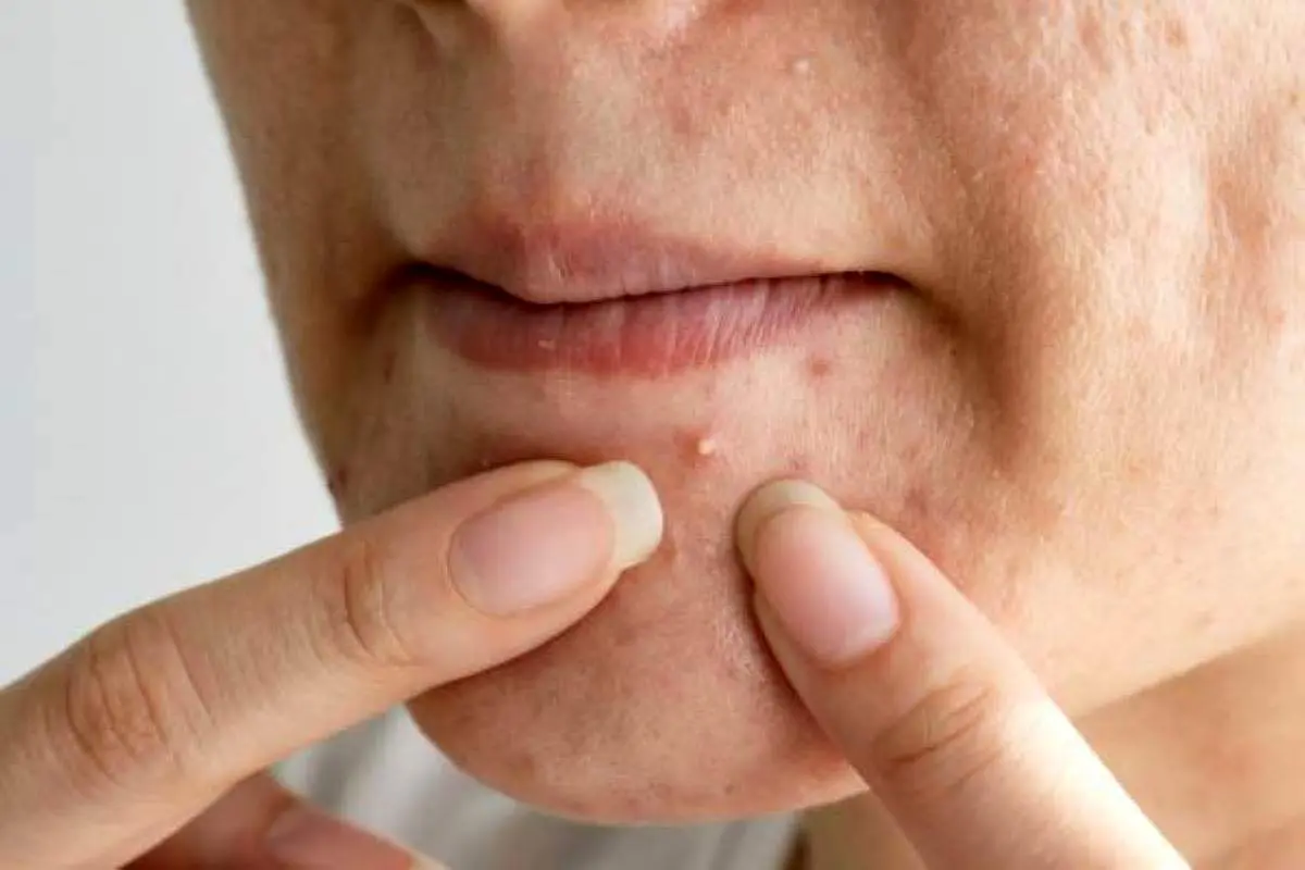 درمان سه سوته جوش چانه