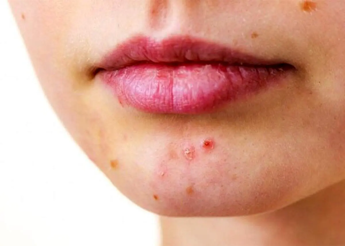 راه حل طلایی برای درمان جوش چانه در کمترین زمان