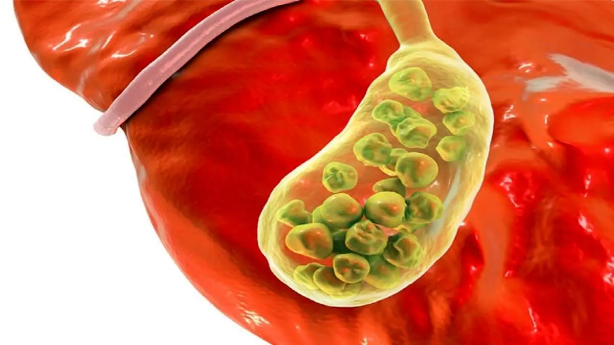 چگونه از بروز سنگ کیسه صفرا جلوگیری کنیم؟