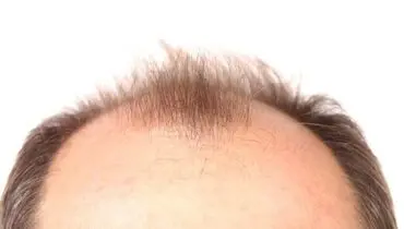 چه کسی مقصر طاسی شما است؟